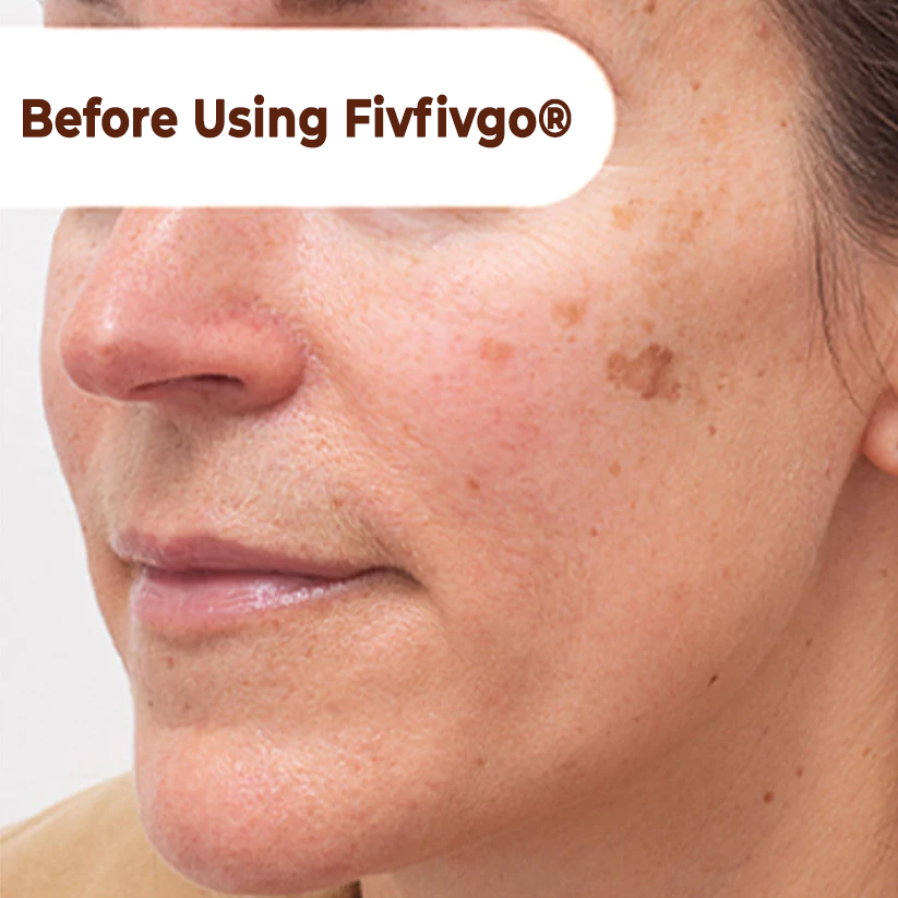 Fivfivgo® Herbal Spots Peel-Off Facial Mask