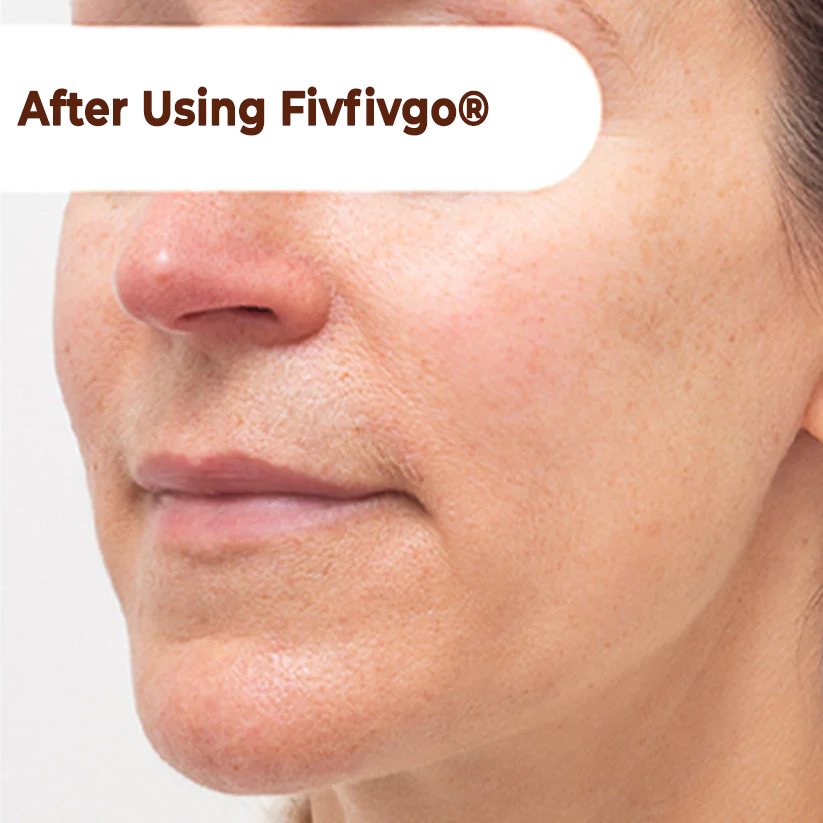 Fivfivgo® Herbal Spots Peel-Off Facial Mask